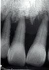 歯周病の歯槽骨